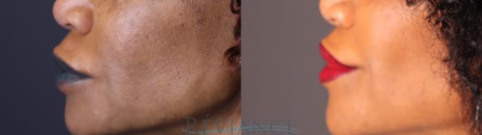 Before & After Lip Lift Case 2239 Left Side View in Portland, OR