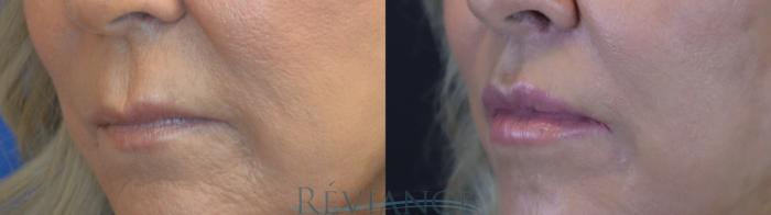 Before & After Lip Lift Case 2240 1/4 View in Portland, OR