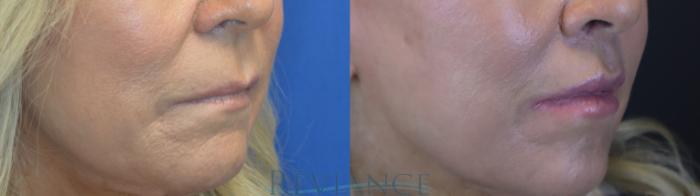 Before & After Lip Lift Case 2240 3/4 View in Portland, OR