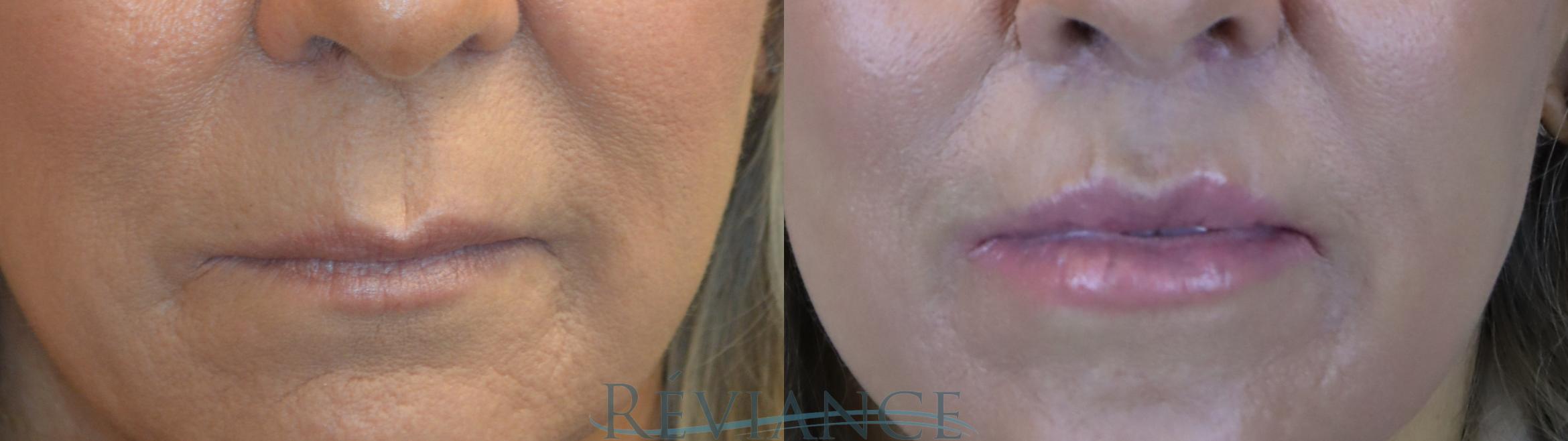 Before & After Lip Lift Case 2240 Front View in Portland, OR