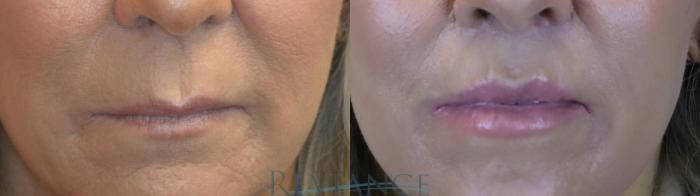 Before & After Lip Lift Case 2240 Front View in Portland, OR