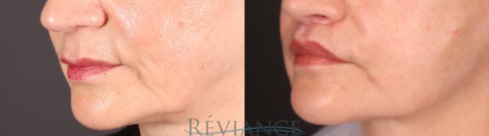 Before & After Lip Lift Case 2241 1/4 View in Portland, OR