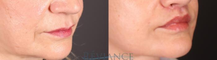Before & After Lip Lift Case 2241 3/4 View in Portland, OR