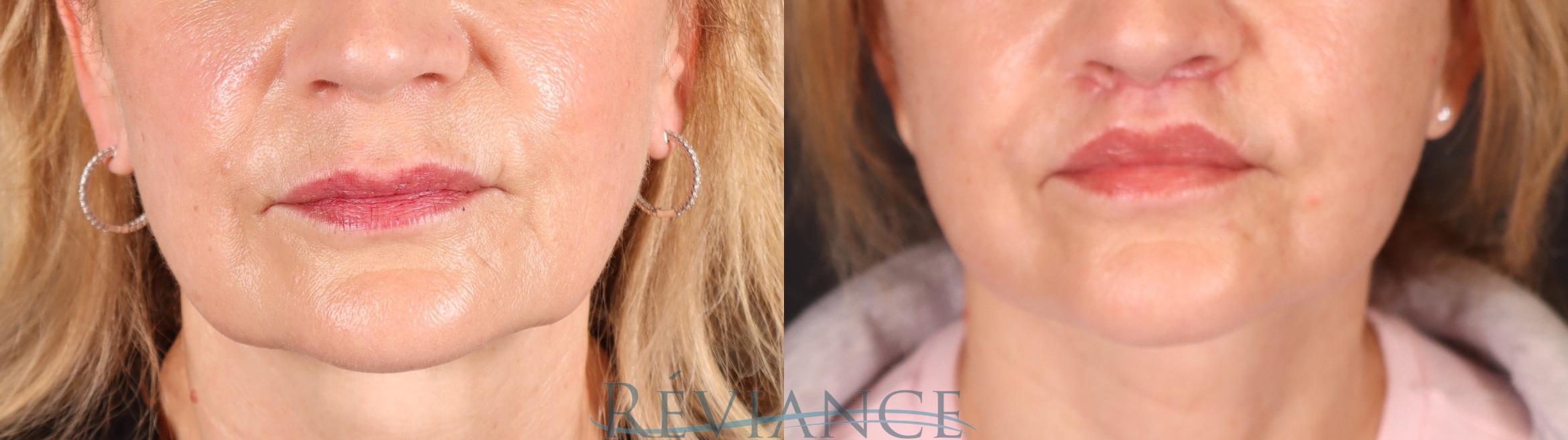 Before & After Lip Lift Case 2241 Front View in Portland, OR