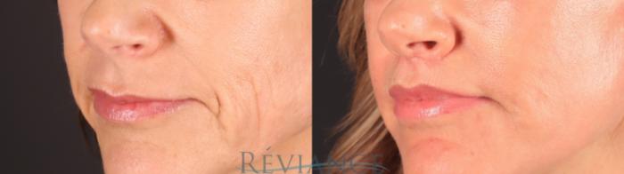 Before & After Lip Lift Case 2244 1/4 View in Portland, OR