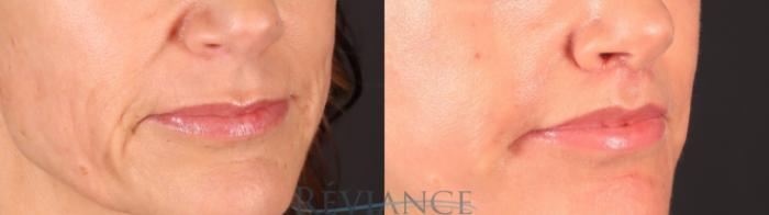 Before & After Lip Lift Case 2244 3/4 View in Portland, OR