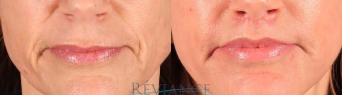 Before & After Lip Lift Case 2244 Front View in Portland, OR