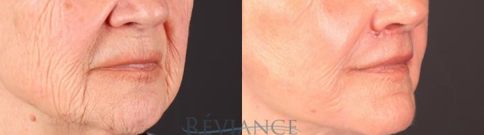 Before & After Lip Lift Case 2252 Left Oblique View in Portland, OR