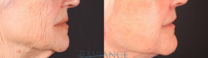 Before & After Lip Lift Case 2252 Left Side View in Portland, OR