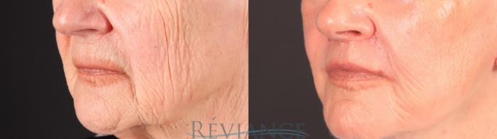 Before & After Lip Lift Case 2252 Right Oblique View in Portland, OR