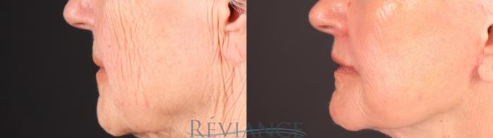 Before & After Lip Lift Case 2252 Right Side View in Portland, OR