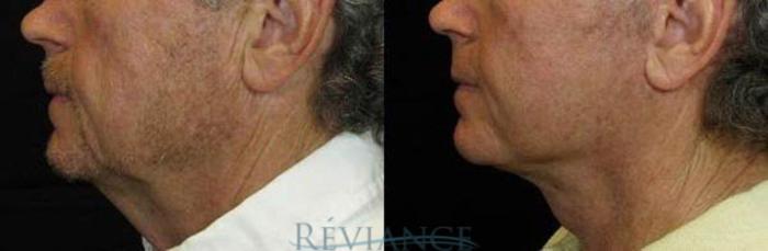 Before & After Mini Facelift Case 83 View #2 View in Portland, OR