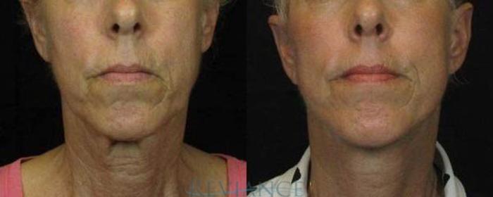 Before & After Mini Facelift Case 89 View #1 View in Portland, OR