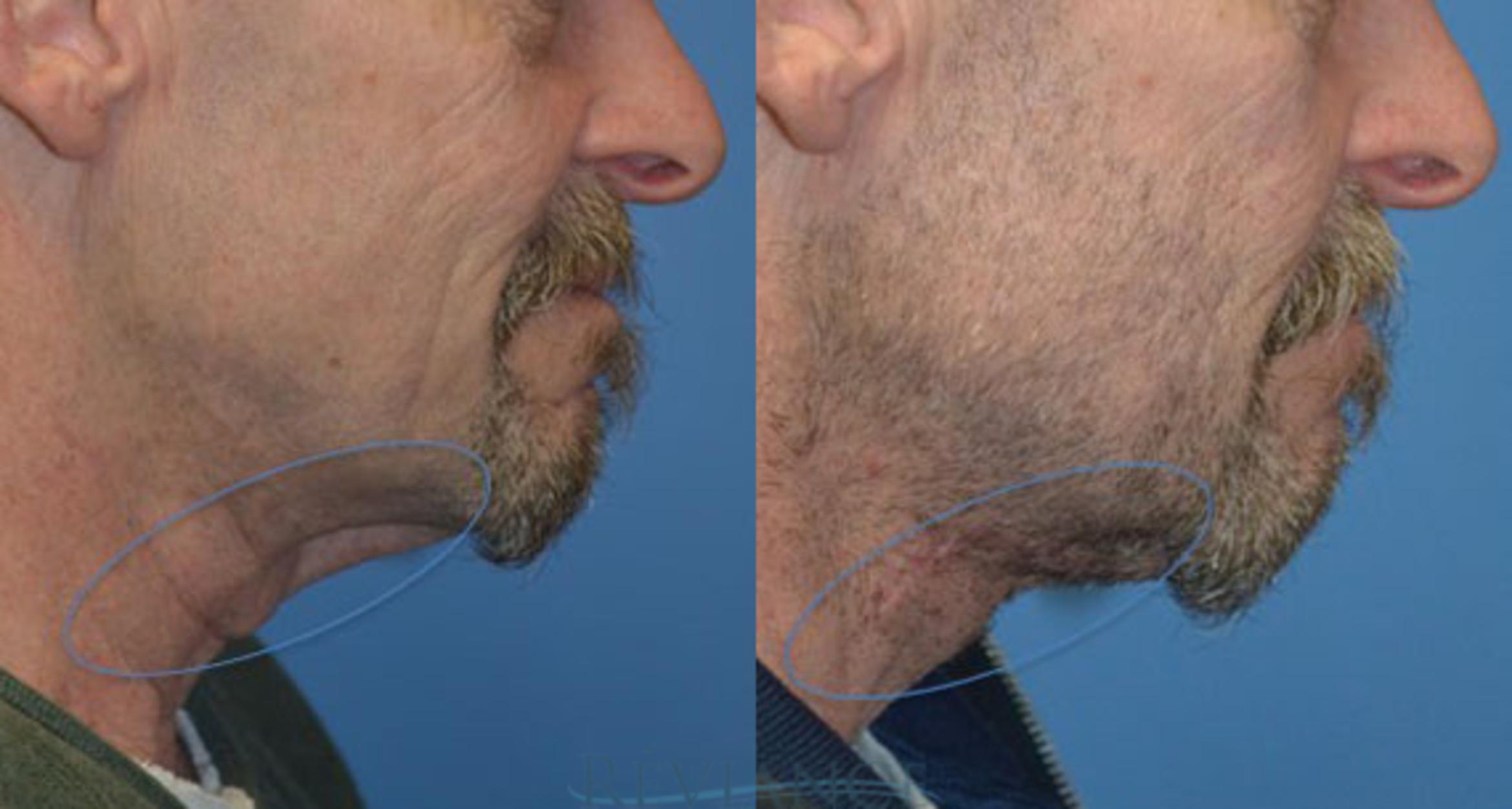 Before & After Neck Lift Case 1251 View #1 View in Portland, OR
