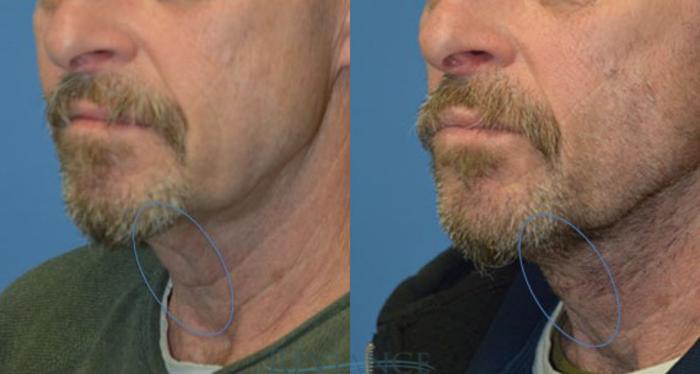 Before & After Neck Lift Case 1251 View #2 View in Portland, OR