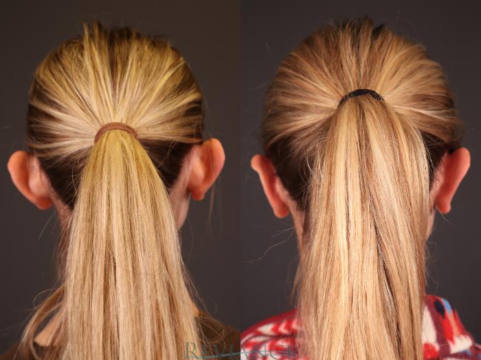 Before & After Otoplasty Case 2249 Back View in Portland, OR
