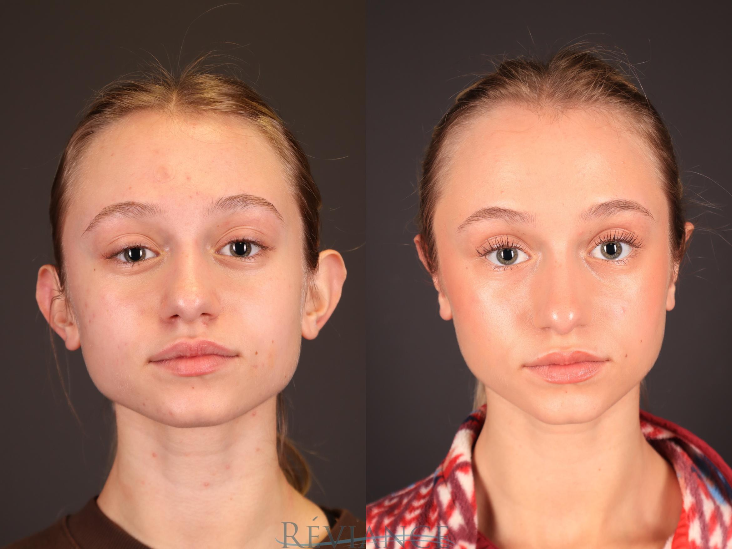 Before & After Otoplasty Case 2249 Front View in Portland, OR