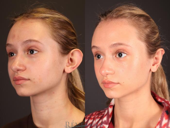 Before & After Otoplasty Case 2249 Left Oblique View in Portland, OR