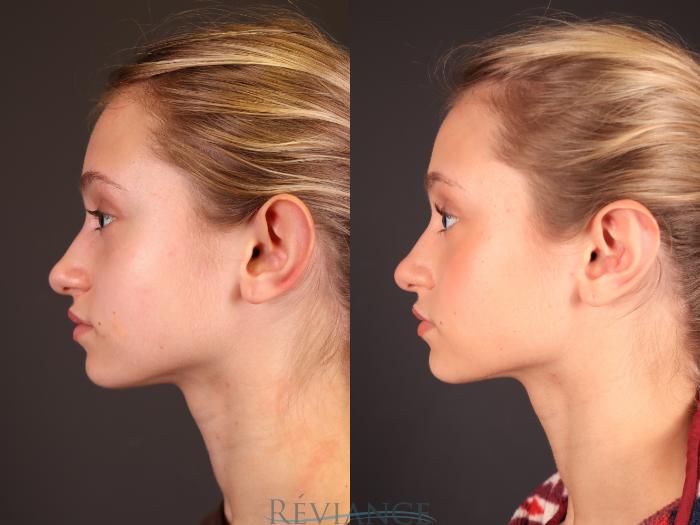 Before & After Otoplasty Case 2249 Left Side View in Portland, OR