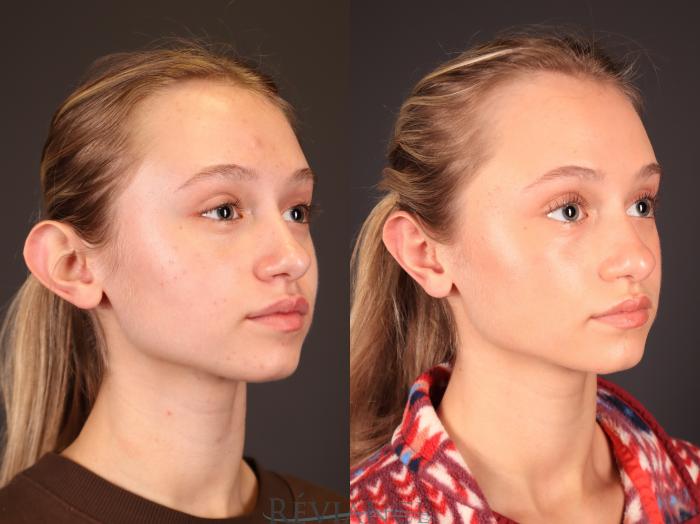 Before & After Otoplasty Case 2249 Right Oblique View in Portland, OR