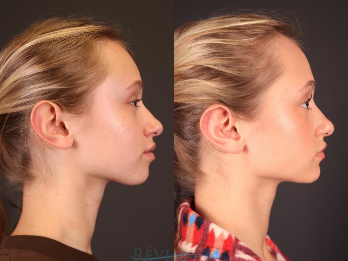 Before & After Otoplasty Case 2249 Right Side View in Portland, OR