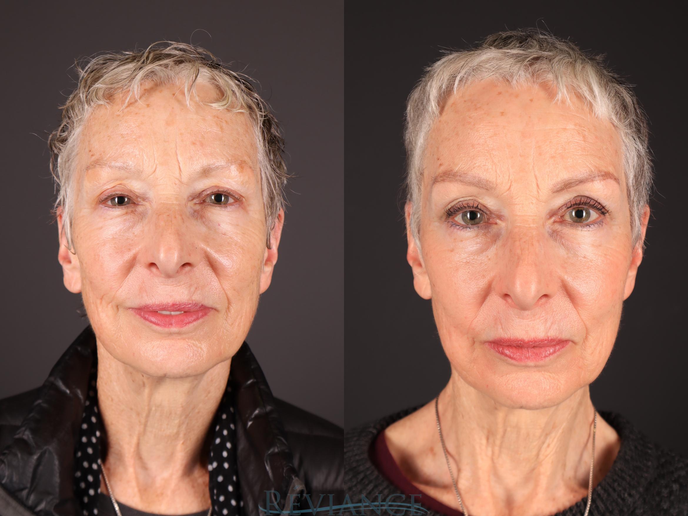Before & After Radiofrequency Microneedling Case 2248 Front View in Portland, OR