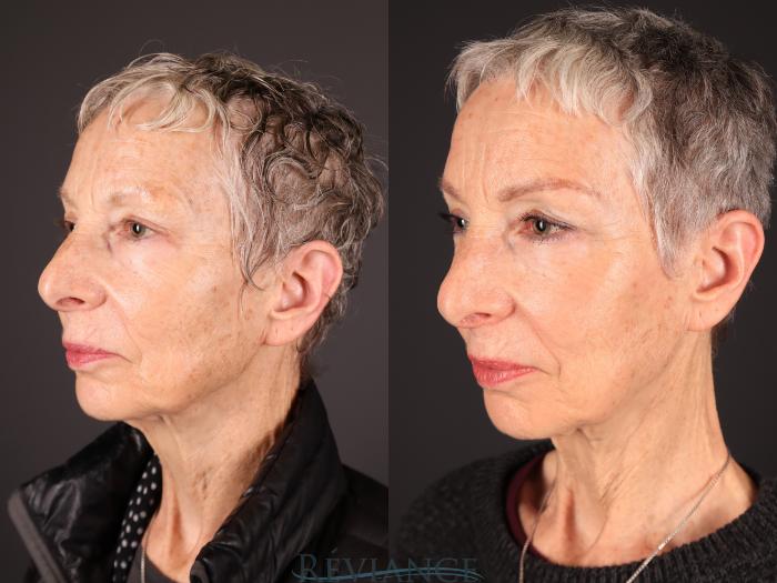 Before & After Radiofrequency Microneedling Case 2248 Left Oblique View in Portland, OR