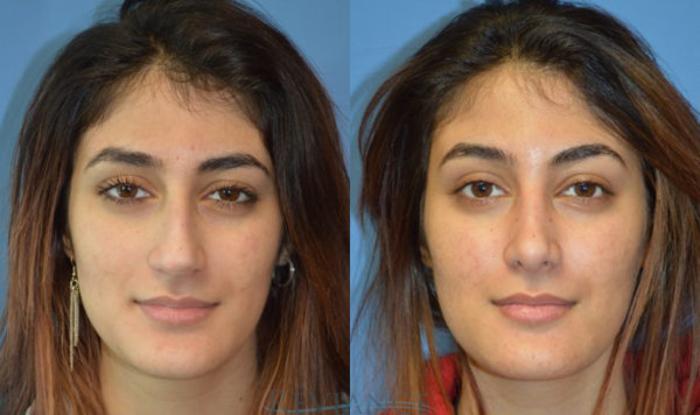 Before & After Rhinoplasty Case 1134 View #1 View in Portland, OR