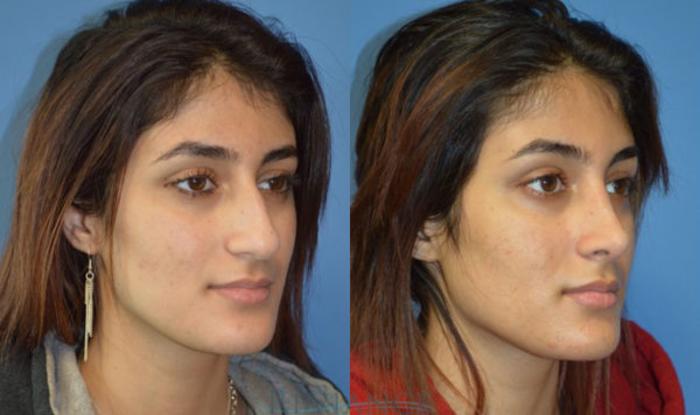 Before & After Rhinoplasty Case 1134 View #2 View in Portland, OR
