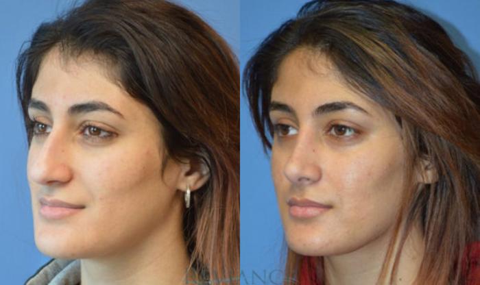 Before & After Rhinoplasty Case 1134 View #3 View in Portland, OR