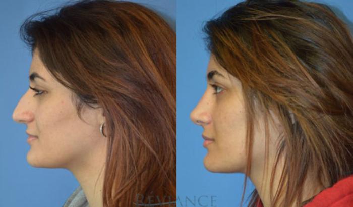 Before & After Rhinoplasty Case 1134 View #4 View in Portland, OR