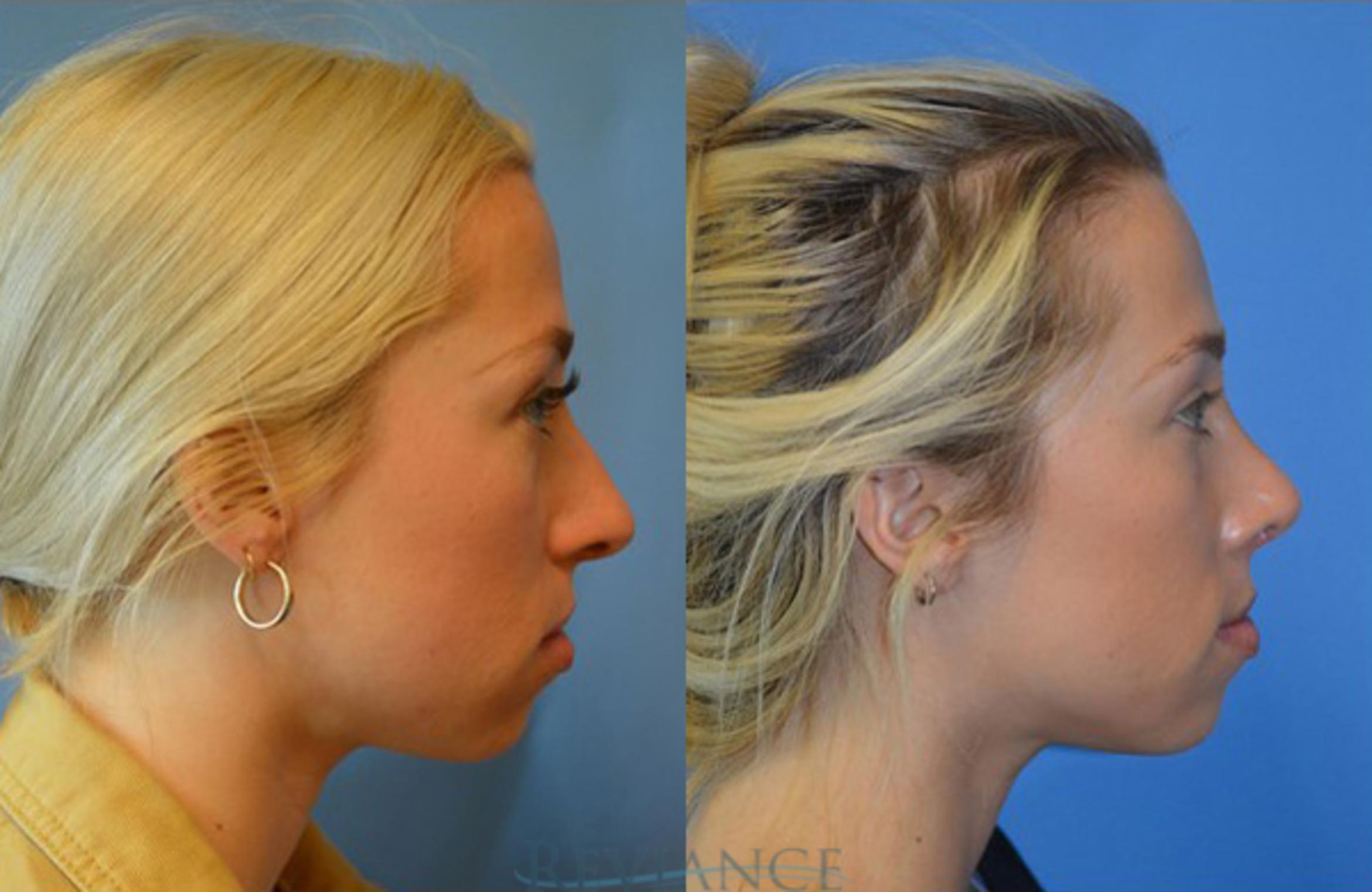 Before & After Rhinoplasty Case 1135 View #1 View in Portland, OR