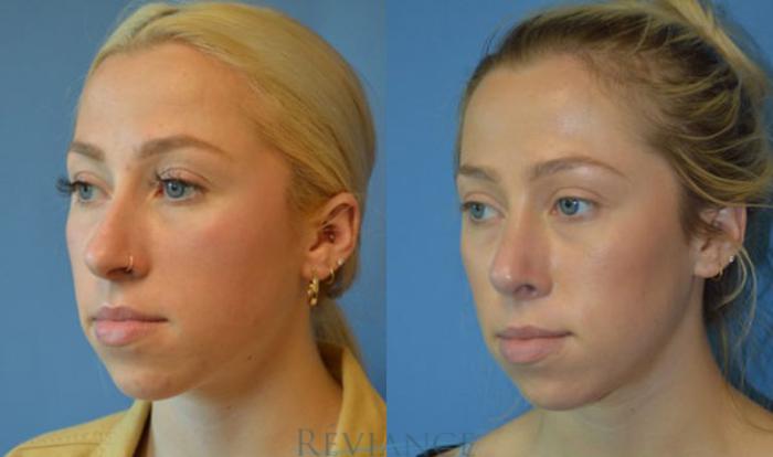 Before & After Rhinoplasty Case 1135 View #2 View in Portland, OR