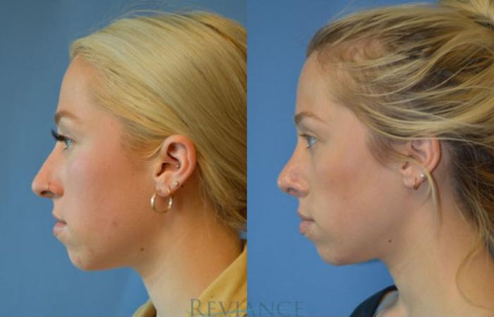 Before & After Rhinoplasty Case 1135 View #3 View in Portland, OR