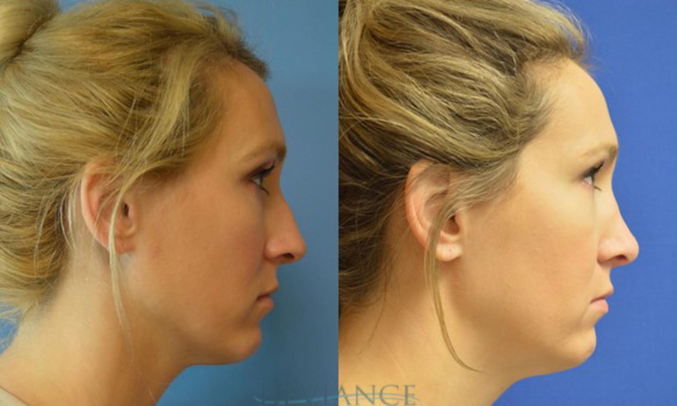 Before & After Rhinoplasty Case 1136 View #1 View in Portland, OR