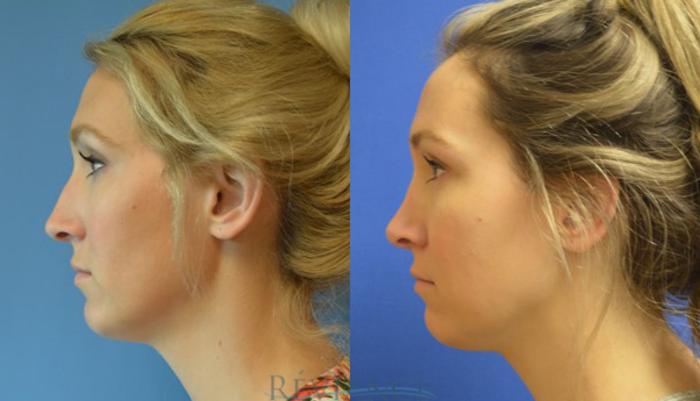 Before & After Rhinoplasty Case 1136 View #2 View in Portland, OR