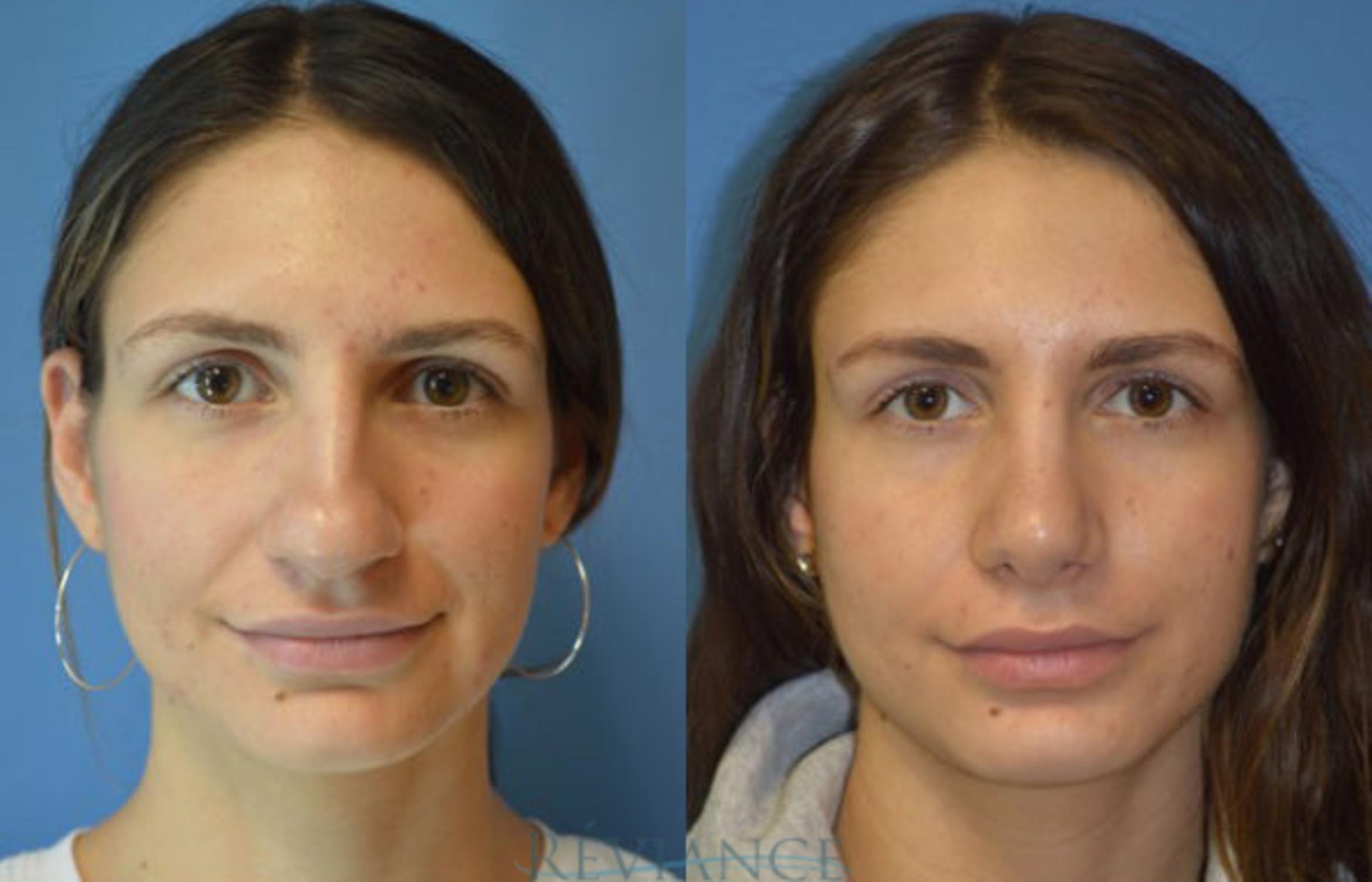 Before & After Rhinoplasty Case 1137 View #1 View in Portland, OR