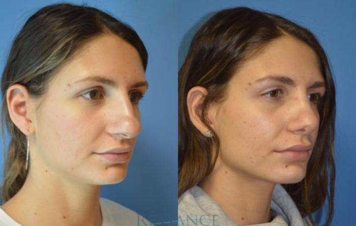 Before & After Rhinoplasty Case 1137 View #2 View in Portland, OR