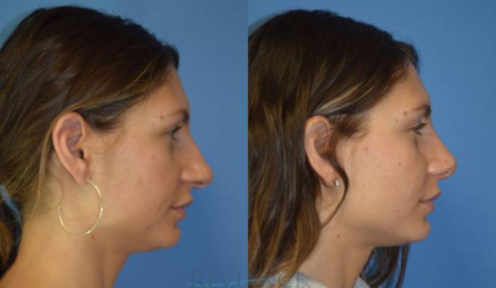 Before & After Rhinoplasty Case 1137 View #3 View in Portland, OR