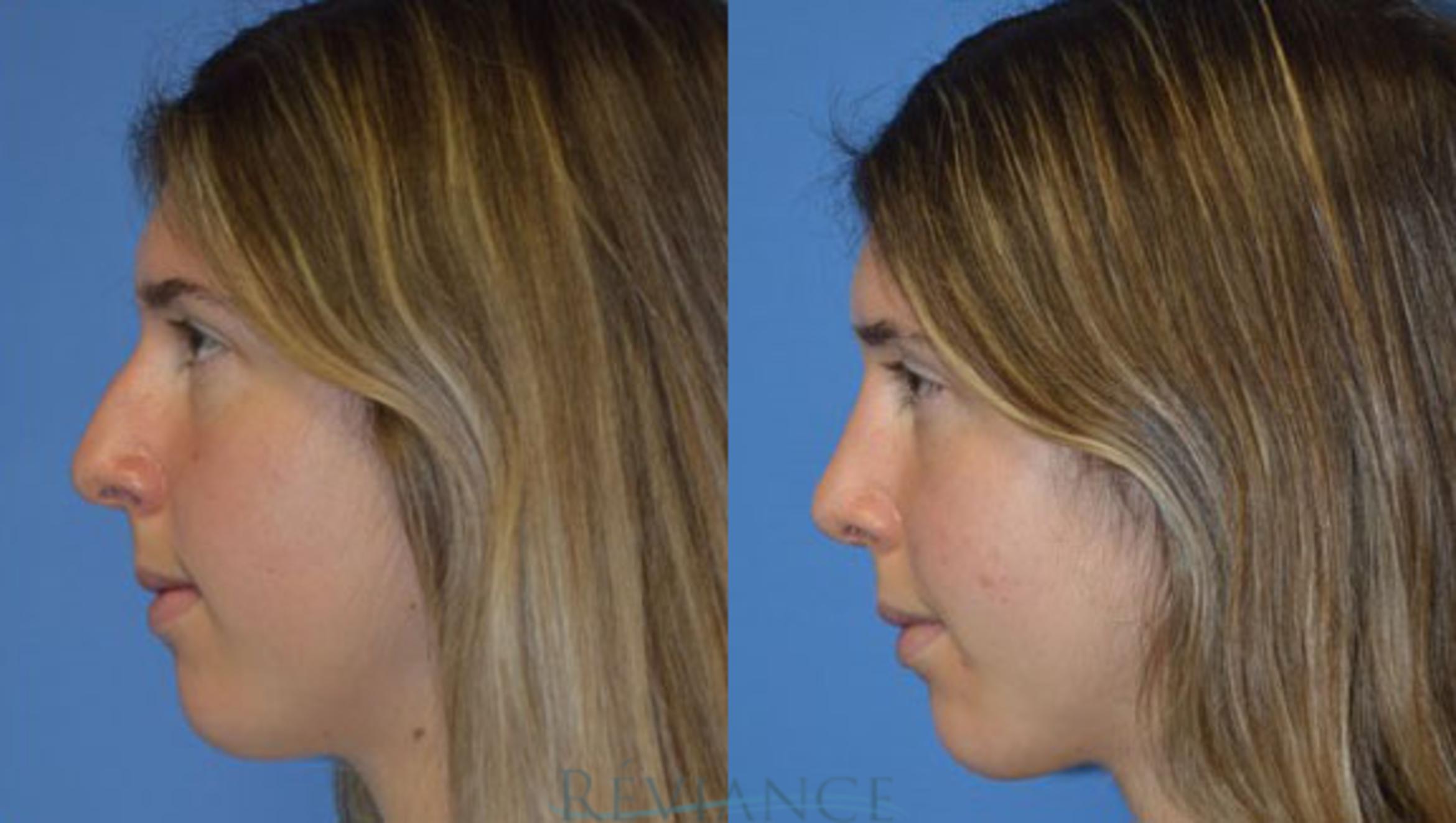 Before & After Rhinoplasty Case 1257 View #1 View in Portland, OR