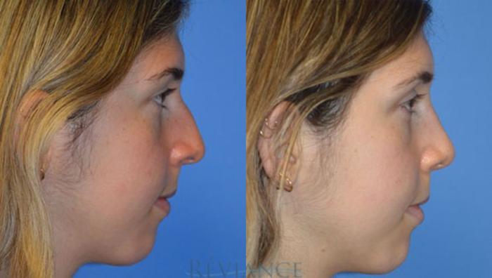 Before & After Rhinoplasty Case 1257 View #2 View in Portland, OR