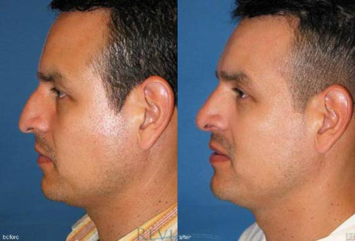 Before & After Rhinoplasty Case 189 View #1 View in Portland, OR