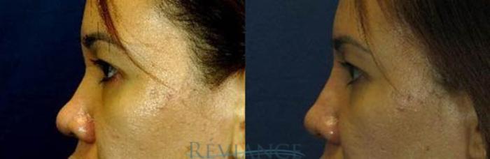 Non surgical rhinoplasty