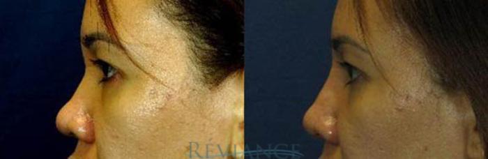Before & After Rhinoplasty Case 193 View #1 View in Portland, OR