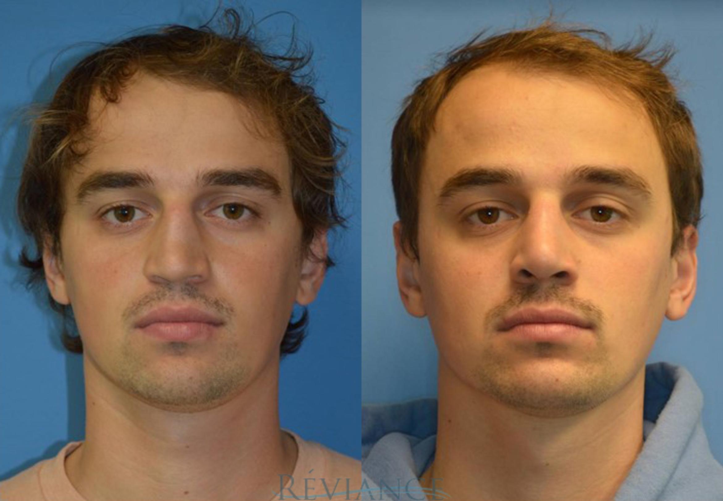 Before & After Rhinoplasty Case 2110 View #1 View in Portland, OR