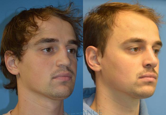 Before & After Rhinoplasty Case 2110 View #2 View in Portland, OR