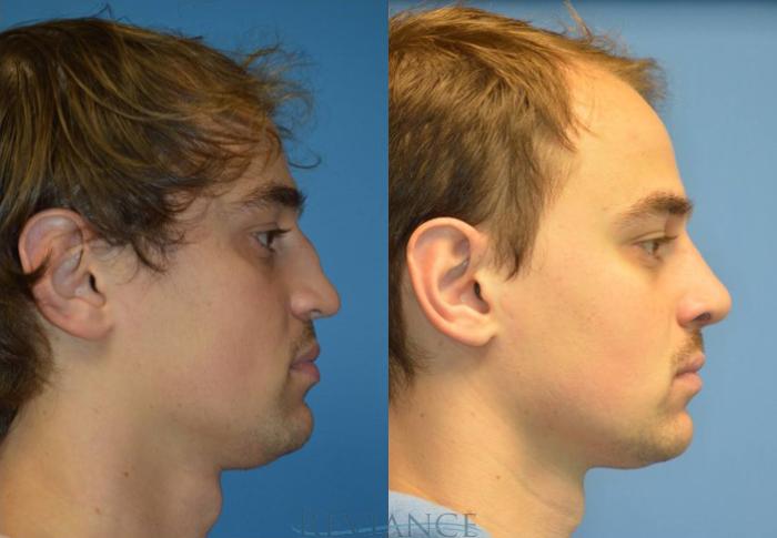 Before & After Rhinoplasty Case 2110 View #3 View in Portland, OR