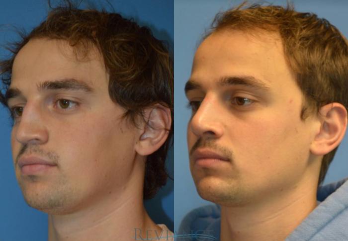 Before & After Rhinoplasty Case 2110 View #4 View in Portland, OR