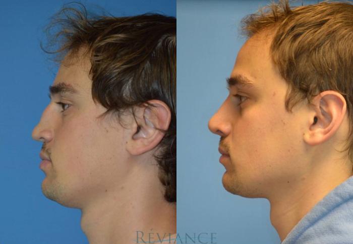 Before & After Rhinoplasty Case 2110 View #5 View in Portland, OR