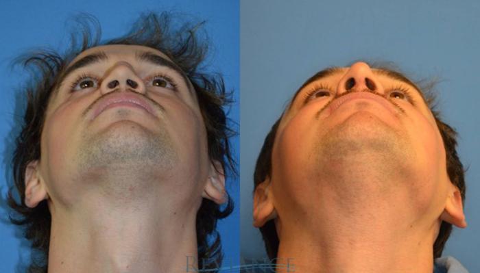 Before & After Rhinoplasty Case 2110 View #6 View in Portland, OR